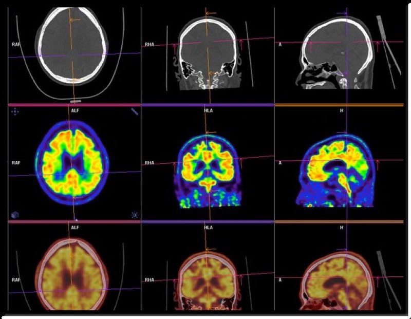 Brain scan psycoactive effects of HHC